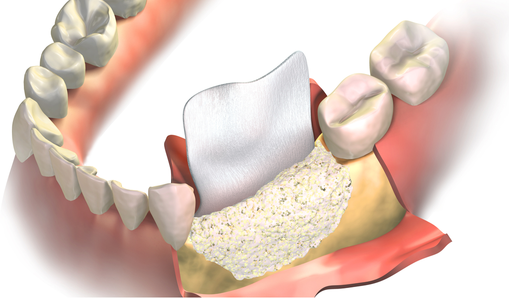 Rigenerazione dentale ossea GBR